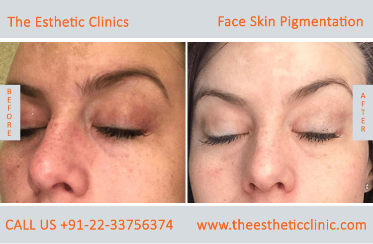 Face Skin Pigmentation Laser Treatment before after photos in mumbai india (4)